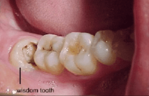 Wisdom tooth